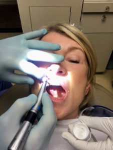 Here I am getting ready for the procedure of bleaching my teeth. First the teeth must be professionally "buffed" to remove any surface stains and tartar. I had just had my teeth cleaned a month ago so this was almost cursory.