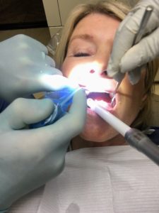 Next, a white rubberized "barrier" is applied to the gums to protect soft tissue from being burned by the bleach.
