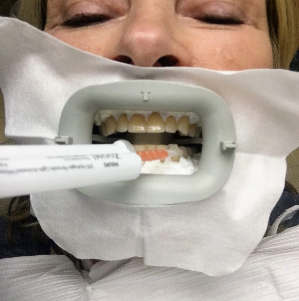 Bleaching My Teeth at Lowenberg, Lituchy & Kantor The Martha Stewart Blog